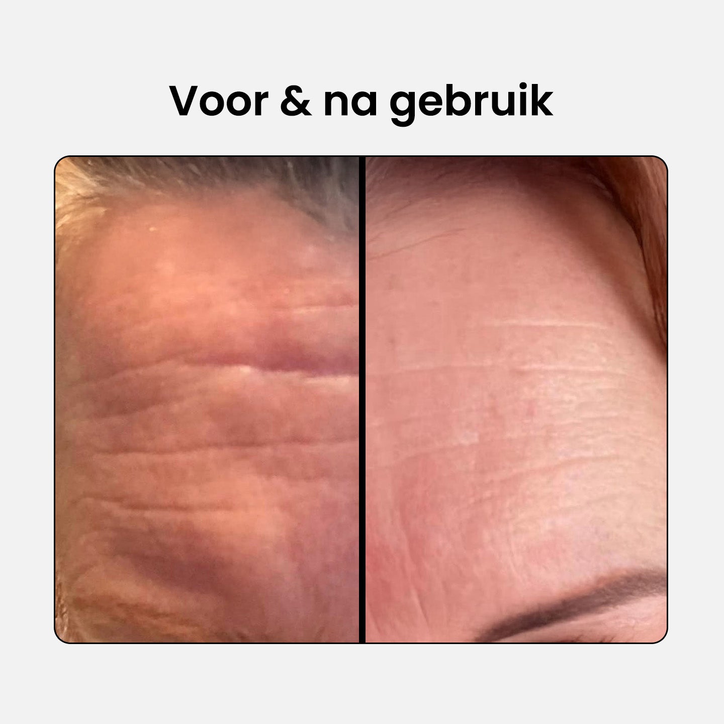 collagen-complex_before-after-1_NL.jpg__PID:4aabe14b-5e35-4821-ae64-3c5abe096cec