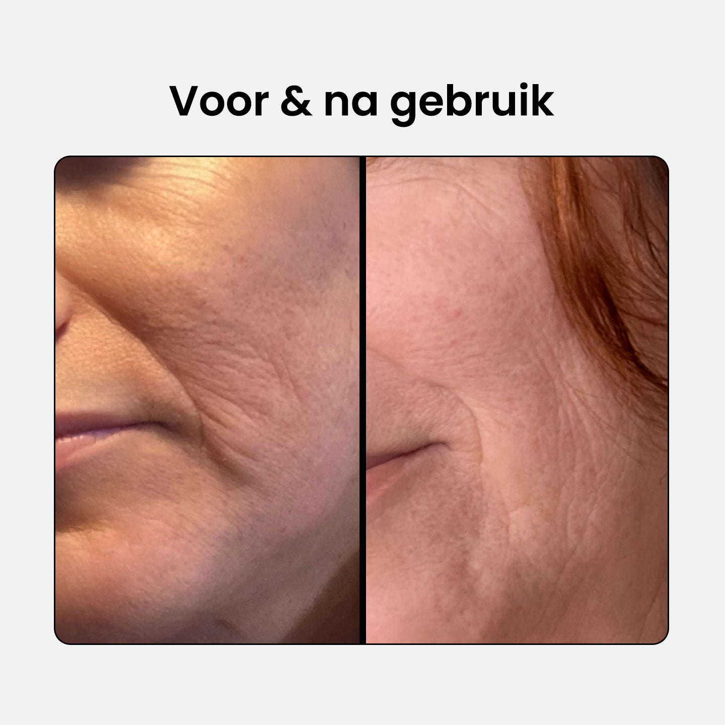 collagen-complex_before-after-2_NL.jpg__PID:abe14b5e-3518-416e-a43c-5abe096cec75
