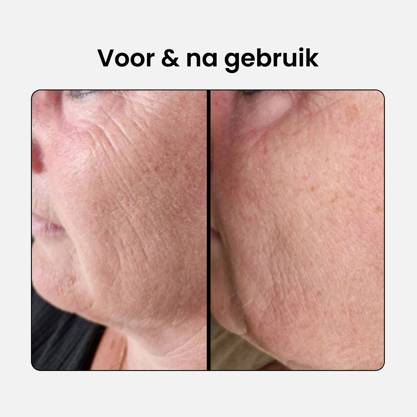 collagen-complex_before-after-3_NL.jpg__PID:e14b5e35-1821-4e64-bc5a-be096cec75f8